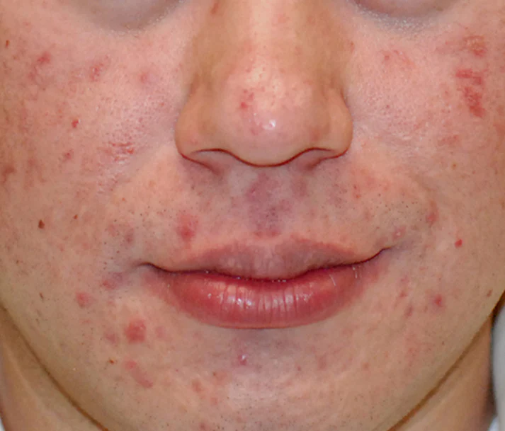 AFTER3_60e781f3-0f33-4a55-8b21-b32c907a9d43 Clearogen Sensitive Skin Acne Clearing 3 Step Treatment with Salicylic Acid - Image 10