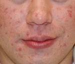 Clearogen Ultimate Acne Clearing 3 Step Treatment with 2.5% Benzoyl Peroxide - Image 4