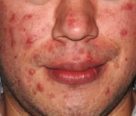 Clearogen Sensitive Skin Acne Clearing 3 Step Treatment with Salicylic Acid - Image 8