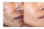 Clearogen Sensitive Skin Acne Clearing 3 Step Treatment with Salicylic Acid - Image 9
