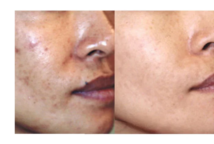 Clearogen Sensitive Skin Acne Clearing 3 Step Treatment with Salicylic Acid - Image 9