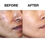 Clearogen Acne Foaming Cleanser - Image 6
