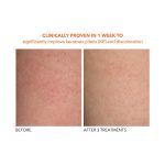 Dr. Dennis Gross Alpha Beta® Exfoliating Body Treatment - Image 6