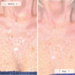 Omnilux Contour NECK & DÉCOLLETÉ - Image 10