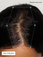 Nutrafol Women Hair Growth Nutraceutical - Image 4