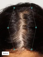 Nutrafol Women Hair Growth Nutraceutical - Image 5