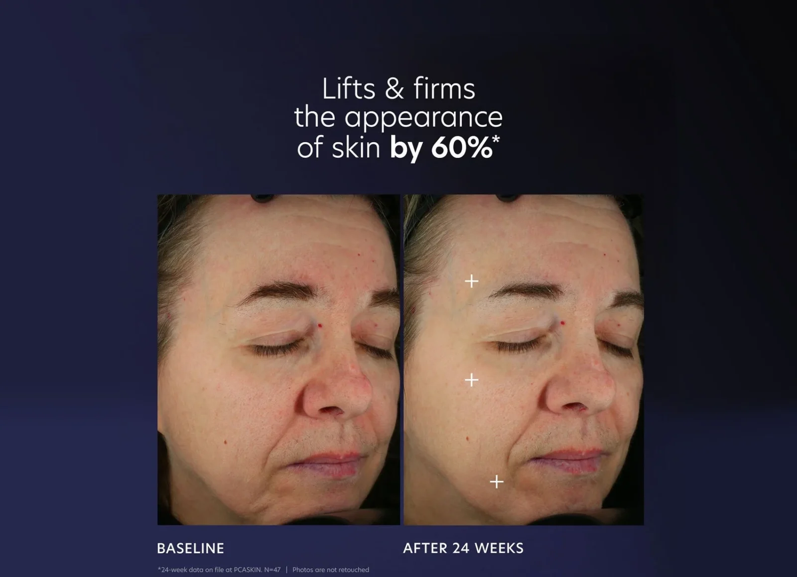 Pro-maxbeforeandafter1_cb1e2ae9-eb70-43d4-bdd7-98bf7353d141 PCA SKIN Pro-Max Age Renewal - Image 6