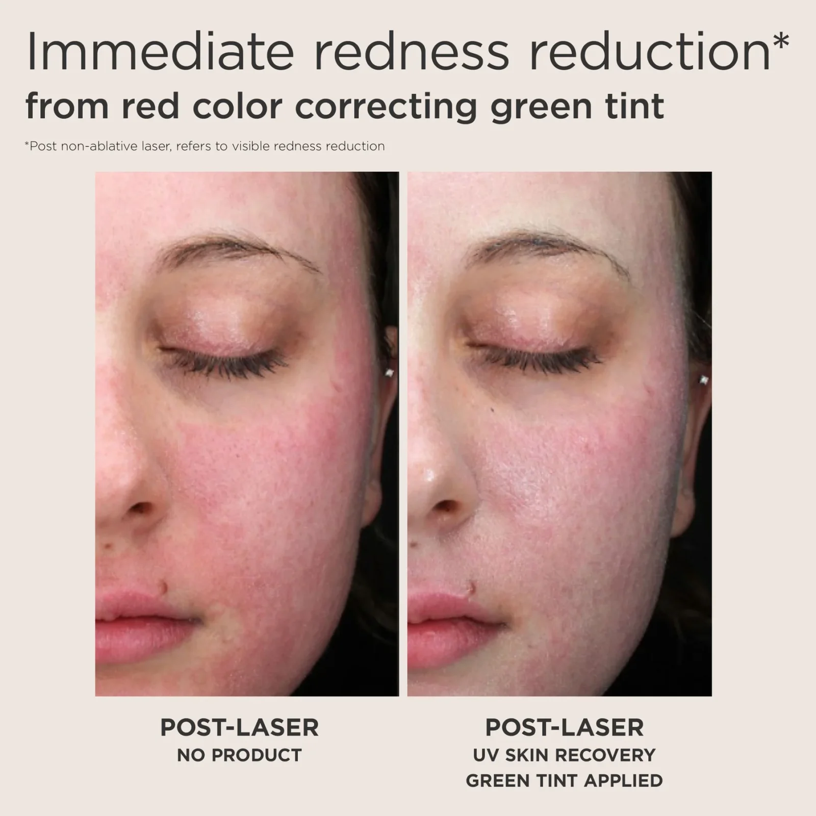 312172_UVSkinRecovery_PDPThumbnails_2400x2400_2_Green_Tint_Only__Feature_Post_procedure_before_after_to_showcase_redn_1800x1800 EltaMD UV Skin Recovery Red Color Correcting Green Tint Broad Spectrum SPF 50 - Image 6