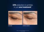 PCA Skin Hyaluronic Acid Microneedle Eye Patches - Image 7