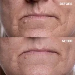 Wrinkles Schminkles Mouth & Lip Wrinkle Patches - Image 9