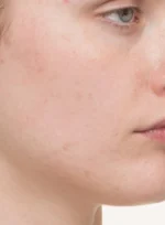 Nutrafol Clear Skin Nutraceutical (for Women 18+) - Image 4