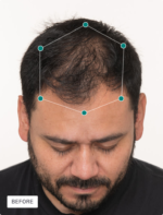 Nutrafol Men + DHT Inhibitor - Image 7