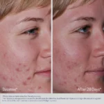 Obagi Acne Therapeutic System - Image 6
