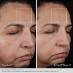 Obagi ELASTIderm Advanced Filler Concentrate - Image 5