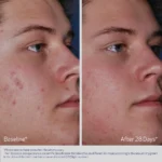 Obagi Acne Therapeutic System - Image 5