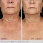 Obagi ELASTIderm Neck and Decollete Concentrate - Image 6