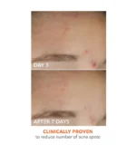 Dr. Dennis Gross Alpha Beta® On the Spot Eliminator 2% Salicylic Acid Acne Treatment Gel - Image 3
