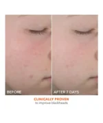 Dr. Dennis Gross Alpha Beta® On the Spot Eliminator 2% Salicylic Acid Acne Treatment Gel - Image 4