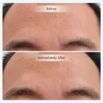 INVITY Youth Activating Instant Filler V2 - Image 4